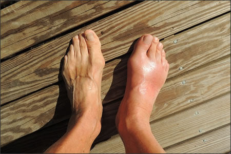 Treating Lymphedema